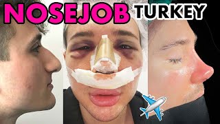 I got my 4th NOSEJOB in TURKEY ✈️ Full Vlog and Surgery Tips [upl. by Oeak]