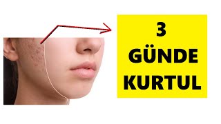 SİVİLCEDEN 3 GÜNDE KURTARAN EN ETKİLİ VE BASİT FORMÜL [upl. by Henriha]