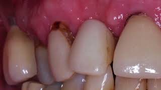 Cariology Part 7 Types of Caries [upl. by Agnew]