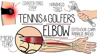 Understanding Tennis Elbow and Golfers Elbow Lateral amp Medial Epicondylitis [upl. by Sanford374]