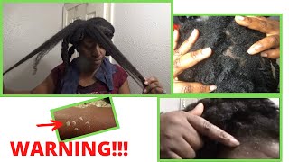 Hair Loss  Dry Scalp  Seborrheic Dermatitis  Alopecia  Psoriasis [upl. by Latreshia]