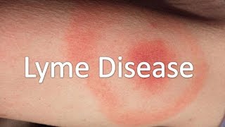 Lyme Disease [upl. by Hartwell]