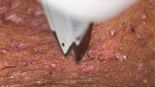 Ingrown Hair Removal 15 [upl. by Nelleeus]