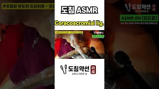 ACUPOTOMY ASMR Coracoacromial ligament  오구견봉인대 초음파 도침치료 [upl. by Ahsienom881]