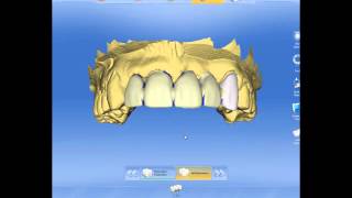 cadcam bridge [upl. by Adnyl]