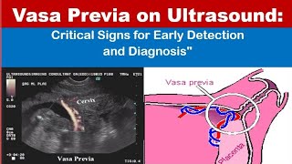 Vasa previa on Ultrasound [upl. by Nivloc]