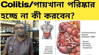 Colitis  পায়খানা পরিষ্কার না হলে কী করবেন  HealthAwareness637 [upl. by Adnohsek610]