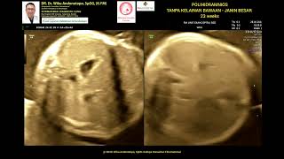 Polihidramnios tanpa kelainan bawaan 23 weeks bayi besar [upl. by Nahtanohj]