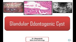 Glandular Odontogenic Cyst [upl. by Ayot]