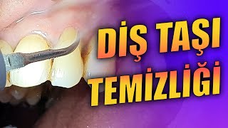 Diş Taşı Temizliği ve Kök Yüzeyi Düzleştirmesi [upl. by Naejarual]