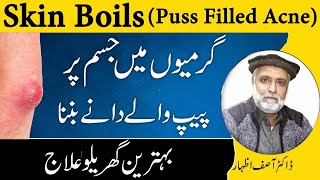 Puss Filled Acne CausesSymptoms And Treatment In Urdu [upl. by Cohlier]