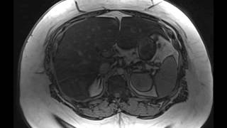 Hepatic Steatosis [upl. by Aihsiek]