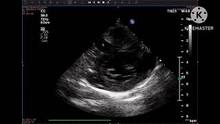 Mal alignment VSD with severe PS [upl. by Noiz]