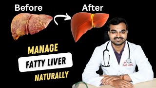 No More Fatty Liver  Dont Wait For Symptoms  Change Lifestyle [upl. by Nanni]