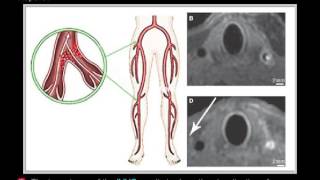 Intravascular ultrasound [upl. by Annaed]