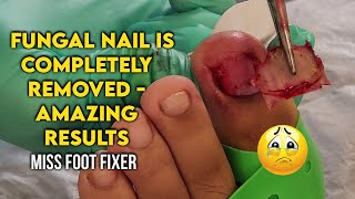 Watch as Fungal Nail is Completely Removed  Amazing Results Miss foot fixer [upl. by Say100]