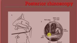 ENT LECTURES  Nasal polyp  ANTROCHOANAL POLYP [upl. by Suired]