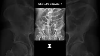 Postoperative ileus Abdominal Xray Abnormalities Postoperative ileus 66 radiologychannel007 [upl. by Aay]