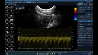 IQ43 TCD TRANSCRANIAL DOPPLER HCPP HC ULTRASOUND ECHOPAC ANALYSIS R 206 [upl. by Binni]