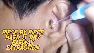 Piece by Piece Hard amp Dry Earwax Extraction [upl. by Nolyd]