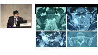 Treatment of sacral insuffciency fractures Debate by Prof Dr Sait Naderi [upl. by Fawn]