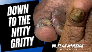 Down To The Nitty Gritty Trimming Fungal Toenails To Get To A Cure [upl. by Amir]