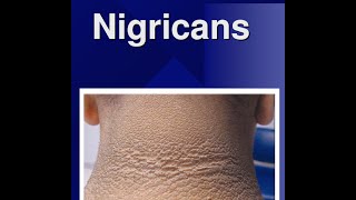 Acanthosis Nigricans [upl. by Adnaloj77]