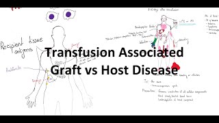 Transfusion Associated Graft Verses Host Disease  TARVHD [upl. by Airenahs696]