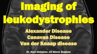 Imaging of Leukodystrophies part 1 Alexander disease Canavan disease and Van Der Knaap Disease [upl. by Pitarys]