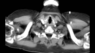 DETAILED CT Anatomy Mediastinum discussion by Radiologist [upl. by Samaria]