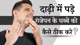 दाढ़ी में पड़े गंजेपन के धब्बे को कैसे ठीक करे  Alopecia Areata Beard  Alopecia Areata Treatment [upl. by Poppo]