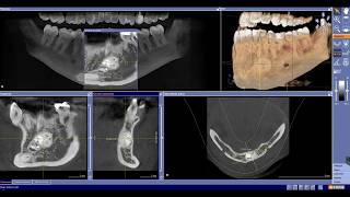 Odontoma complejo al CBCT [upl. by Siaht]