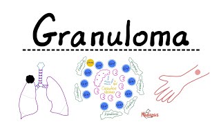 Granuloma  Caseating Noncaseating Epithelioid Cells Histiocytes  Tuberculoma Leproma Gumma [upl. by Kcinomod595]