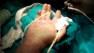 Flexor Tendon Sheath WashoutMOV [upl. by Ramaj186]