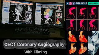 CECT Coronary Angiography With Filming  By Anis Qureshi [upl. by Severen]