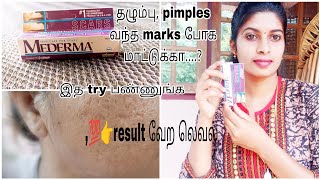 Mederma 👉💯 தழும்பு🤣pimples வந்த scars போகவே மாட்டுக்காஇத மட்டும் try பண்ணுங்க [upl. by Benia]