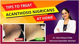 Dark Patch Acanthosis Nigricans Treatment by Dr Tanvi Mayur Patel [upl. by Constantin]