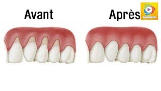 Arrêtez la rétraction de vos gencives et soignezla avec ces remèdes naturels  Random888 [upl. by Enirok]