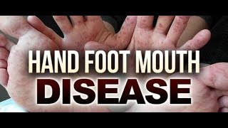 Hand Foot Mouth Disease Food Remedy [upl. by Tiertza345]