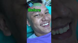 Sebaceous cyst  removal  dr bijay  tokha horizon [upl. by Stew]