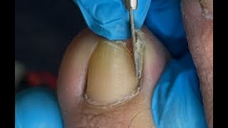 Huge ingrown toenail removal [upl. by Neurath]