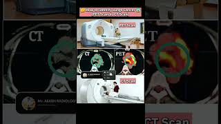 🩻Pet scan Vs CT scan😱 cancer medicalimaging ctscan petscan lungcancer howto youtubeshorts yt [upl. by Falito]