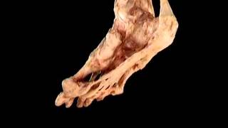 Aclands Video Atlas of Human Anatomy Plantar Fascia [upl. by Ambert]