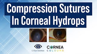 Partial Thickness compression suture for Acute hydrops  Cornea Colours  Season2  Ep2 [upl. by Tillo]