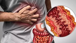 What Is Crohns DiseaseGASTROINTESTINAL DISORDER [upl. by Aehs]