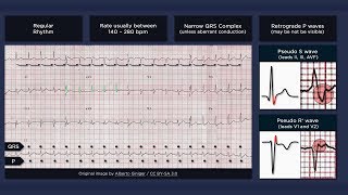 Atrioventricular Nodal Reentry Tachycardia AVNRT ECG [upl. by Marchese385]