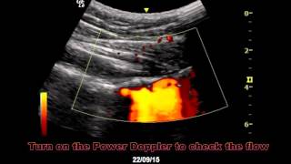 MSK US Guided Posterior Glenohumeral Joint Injection by Dr Stanley Lam [upl. by Pena]