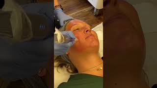 MICRONEEDLING Helps Stimulate Collagen amp TIGHTEN Your Skin microneedling viralvideo shorts [upl. by Annahvas]