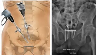 Endoscopic Pelvic Fracture Surgery Koroush Kabir MD [upl. by Layol733]