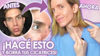 COMO BORRÉ MIS CICATRICES DE ACNE  Recomendaciones de un dermatólogo  Simon Scarano [upl. by Reisman97]